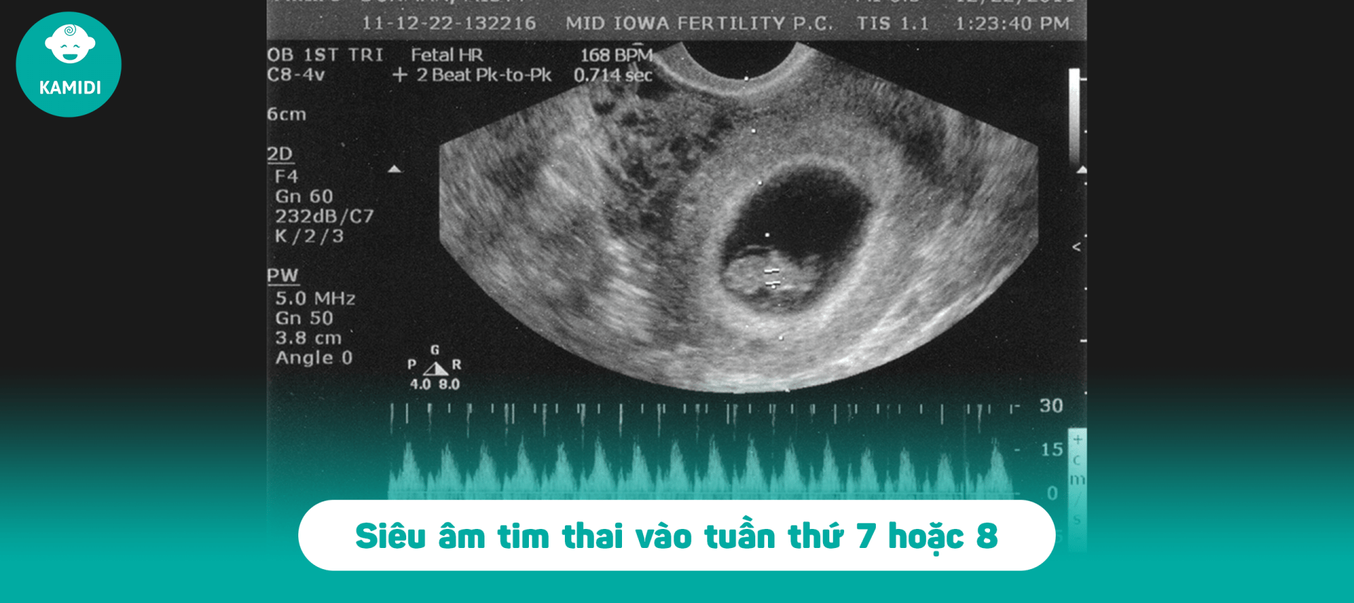 Siêu âm tim thai cũng cần lưu ý 6 điều sau mẹ ơi! 2 sieu-am-tim-thai-4