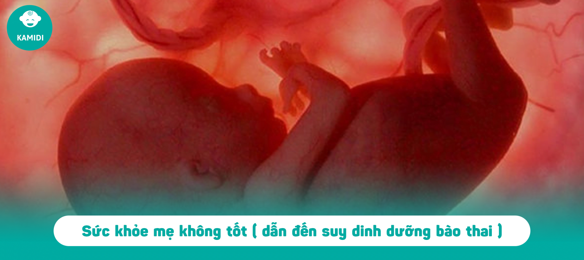 Suy dinh dưỡng bào thai nguy hiểm thế nào, nguyên nhân là gì? 3 suy-dinh-duong-bao-thai-2