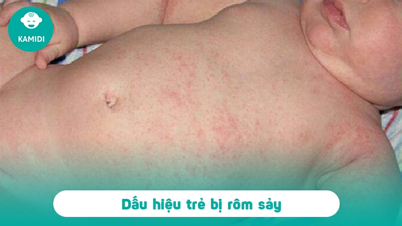 Cách phòng ngừa và điều trị rôm sảy ở trẻ em vào mùa hè 2 dieu-tri-rom-say-o-tre-em-1