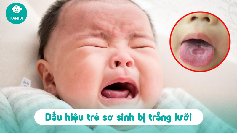 Hướng dẫn cách làm sạch lưỡi bị trắng ở trẻ sơ sinh 2 cach-lam-sach-luoi-bi-trang-o-tre-so-sinh-1