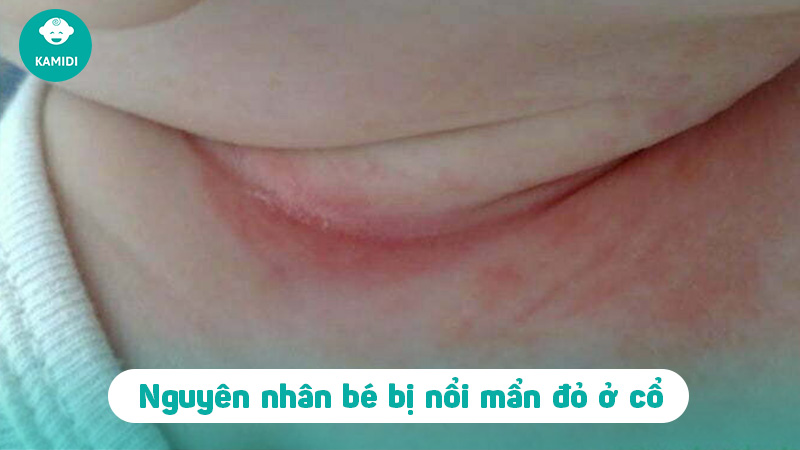 Nguyên nhân bé bị mẩn đỏ ở cổ và cách chữa hiệu quả 2 be-bi-man-do-o-co-1