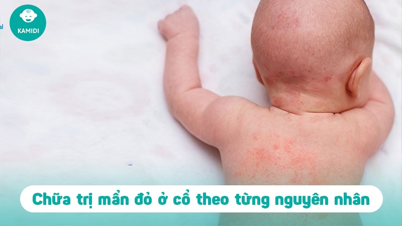 Nguyên nhân bé bị mẩn đỏ ở cổ và cách chữa hiệu quả 3 be-bi-man-do-o-co-2