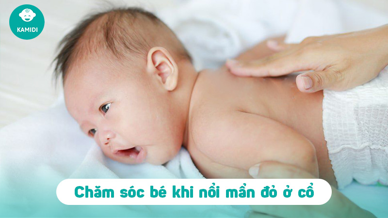 Nguyên nhân bé bị mẩn đỏ ở cổ và cách chữa hiệu quả 4 be-bi-man-do-o-co-3
