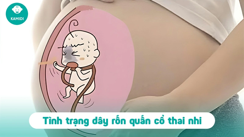 Dây rốn quấn cổ thai nhi có nguy hiểm không? 2 day-ron-quan-co-thai-nhi-1