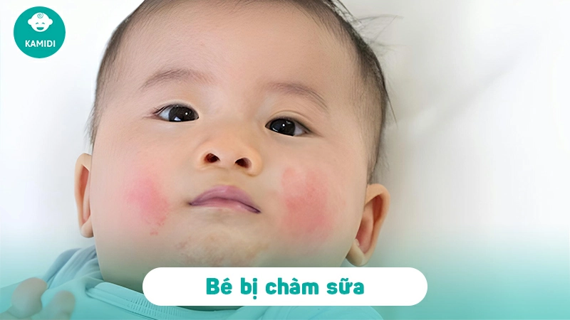 Các bệnh ngoài da ở trẻ sơ sinh mẹ cần lưu ý 3 cac-benh-ngoai-da-o-tre-so-sinh-4