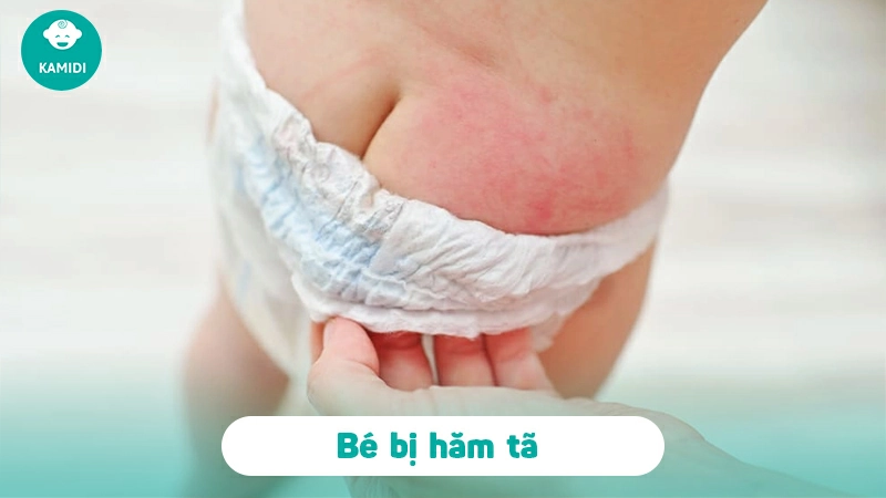 Các bệnh ngoài da ở trẻ sơ sinh mẹ cần lưu ý 4 cac-benh-ngoai-da-o-tre-so-sinh-5