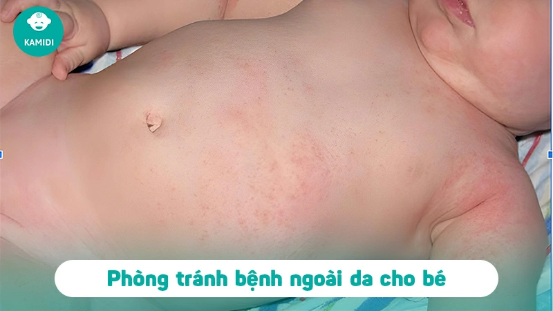 Các bệnh ngoài da ở trẻ sơ sinh mẹ cần lưu ý 5 cac-benh-ngoai-da-o-tre-so-sinh-4