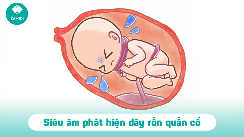 Dây rốn quấn cổ thai nhi có nguy hiểm không? 3 day-ron-quan-co-thai-nhi-2