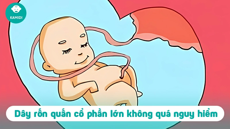 Dây rốn quấn cổ thai nhi có nguy hiểm không? 4 day-ron-quan-co-thai-nhi-3