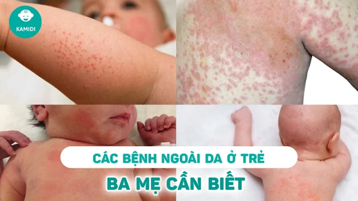 cac-benh-ngoai-da-o-tre-so-sinh