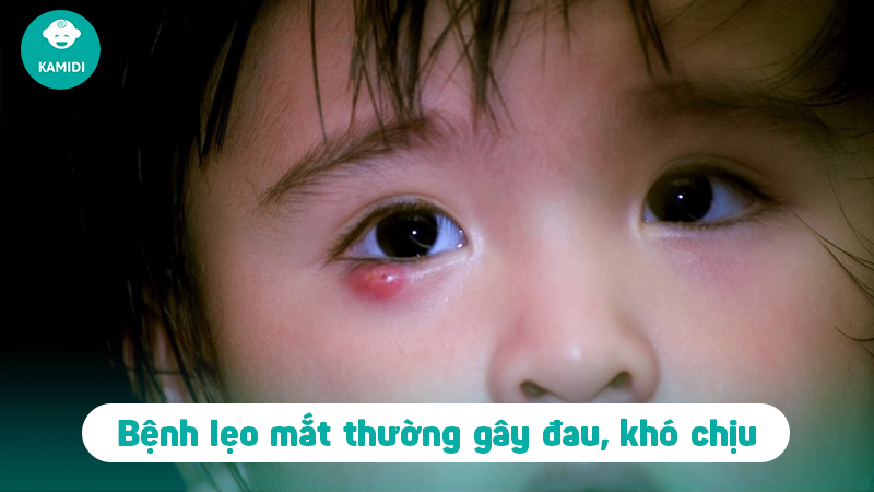Bật mí mẹo chữa lẹo mắt ở trẻ em đơn giản và hiệu quả tại nhà 2 meo-chua-leo-mat-o-tre-em-1