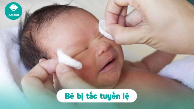 Tắc tuyến lệ ở trẻ sơ sinh: Nguyên nhân và cách xử lý 2 tac-tuyen-le-o-tre-so-sinh-1