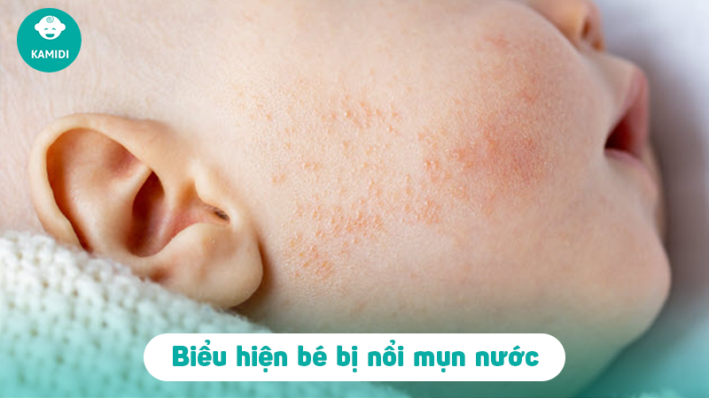 Trẻ sơ sinh bị nổi mụn nước có sao không? 2 tre-so-sinh-bi-noi-mun-nuoc-1