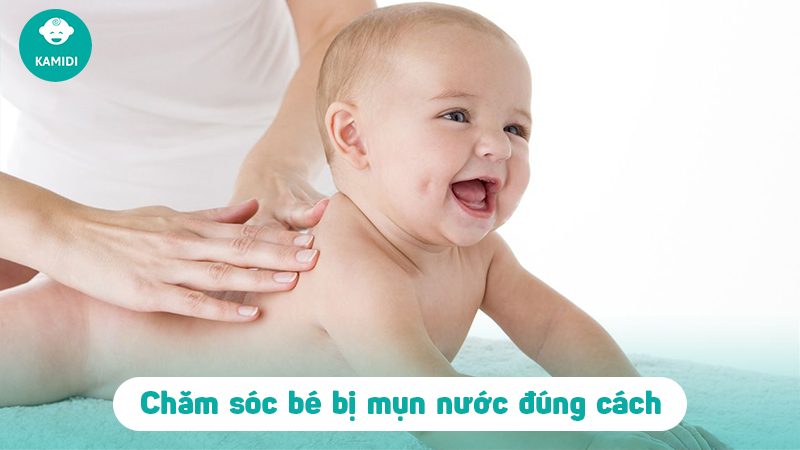 Trẻ sơ sinh bị nổi mụn nước có sao không? 4 tre-so-sinh-bi-noi-mun-nuoc-3