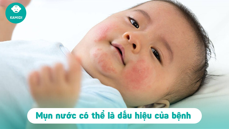 Trẻ sơ sinh bị nổi mụn nước có sao không? 3 tre-so-sinh-bi-noi-mun-nuoc-2