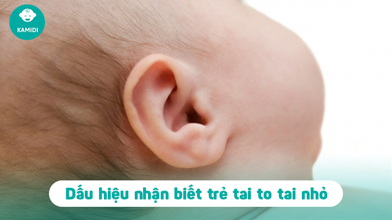 Tai to tai nhỏ ở trẻ sơ sinh: Những điều mẹ cần biết 3 tai-to-tai-nho-o-tre-2
