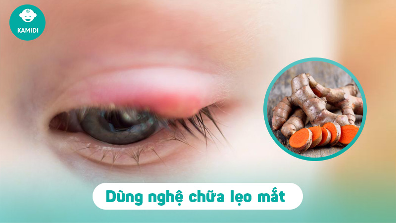 Bật mí mẹo chữa lẹo mắt ở trẻ em đơn giản và hiệu quả tại nhà 5 meo-chua-leo-mat-o-tre-em-4