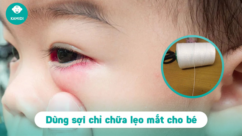 Bật mí mẹo chữa lẹo mắt ở trẻ em đơn giản và hiệu quả tại nhà 6 meo-chua-leo-mat-o-tre-em-5