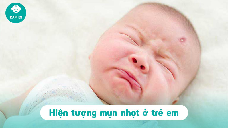 cach-chua-mun-nhot-o-tre-em-1