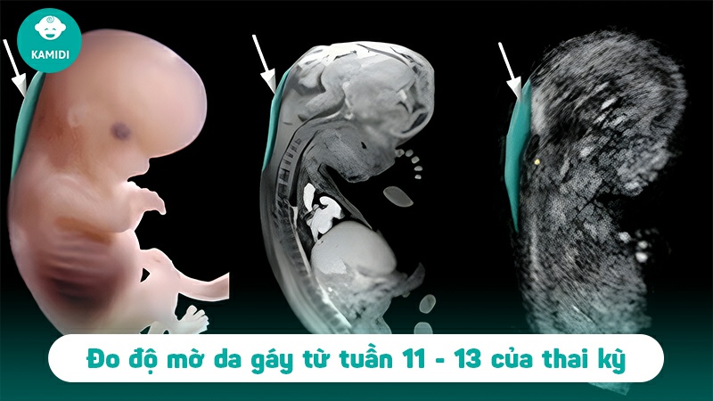 Độ mờ da gáy thai nhi - Vấn đề mẹ khồng thể bỏ qua 4 do-mo-da-gay-thai-nhi-3