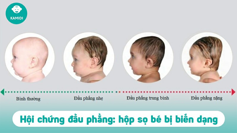 hoi-chung-dau-phang-o-tre-em-1