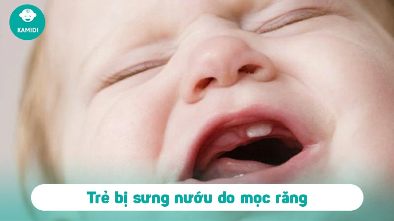 Trẻ bị sưng nướu: Nguyên nhân và cách điều trị 2 tre-bi-sung-nuou-1