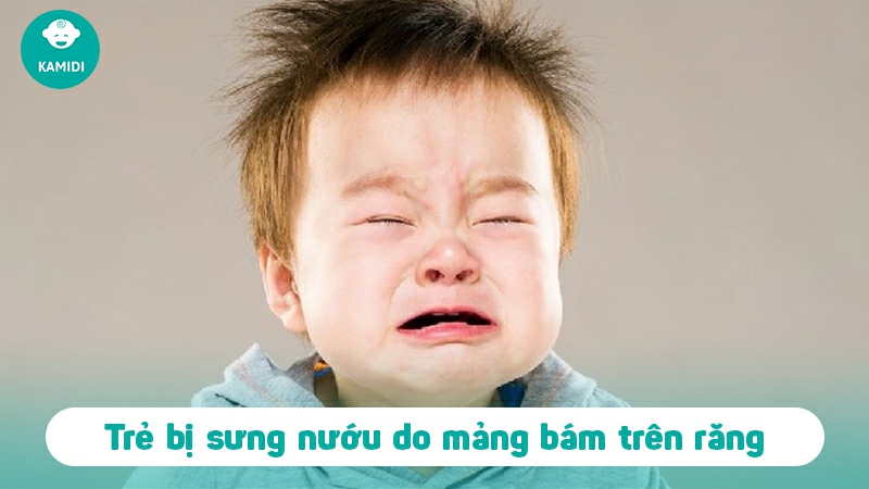 Trẻ bị sưng nướu: Nguyên nhân và cách điều trị 3 tre-bi-sung-nuou-2