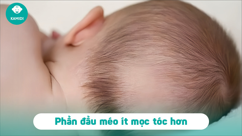 Mẹo dân gian chữa méo đầu ở trẻ sơ sinh hiệu quả mẹ nên biết 3 meo-dan-gian-chua-meo-dau-o-tre-so-sinh-2