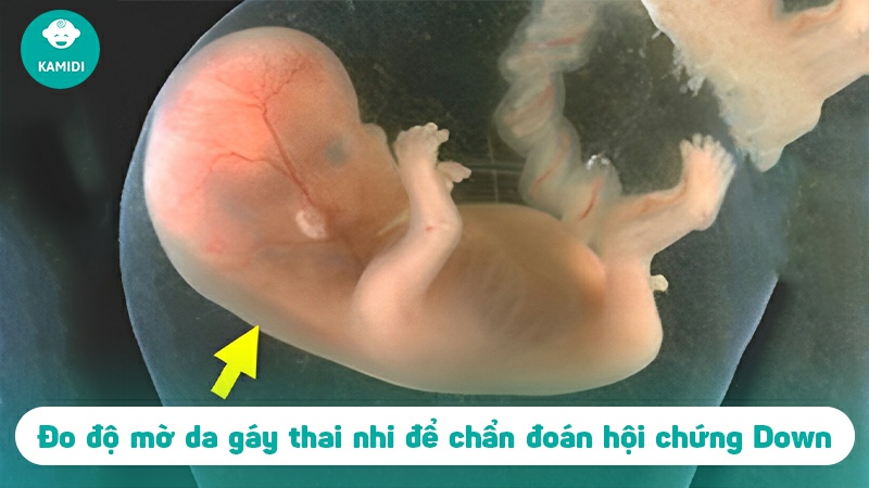 Độ mờ da gáy thai nhi - Vấn đề mẹ khồng thể bỏ qua 2 do-mo-da-gay-thai-nhi-1