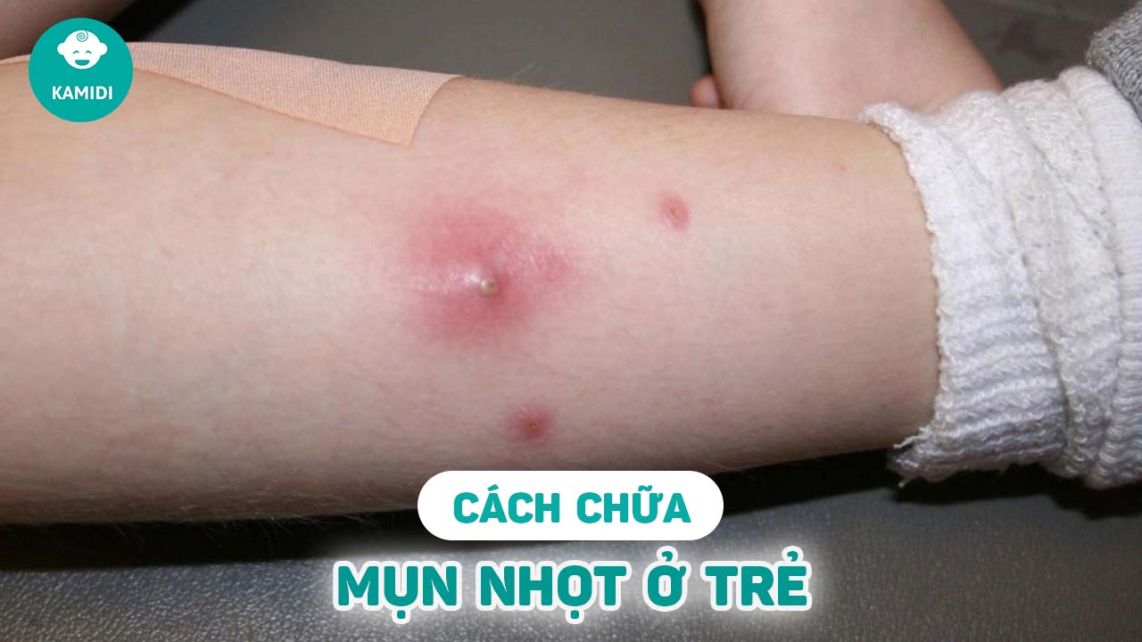 cach-chua-mun-nhot-o-tre-em