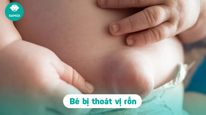 Thoát vị rốn ở trẻ sơ sinh: Nguyên nhân và cách điều trị 2 thoat-vi-ron-o-tre-so-sinh-1