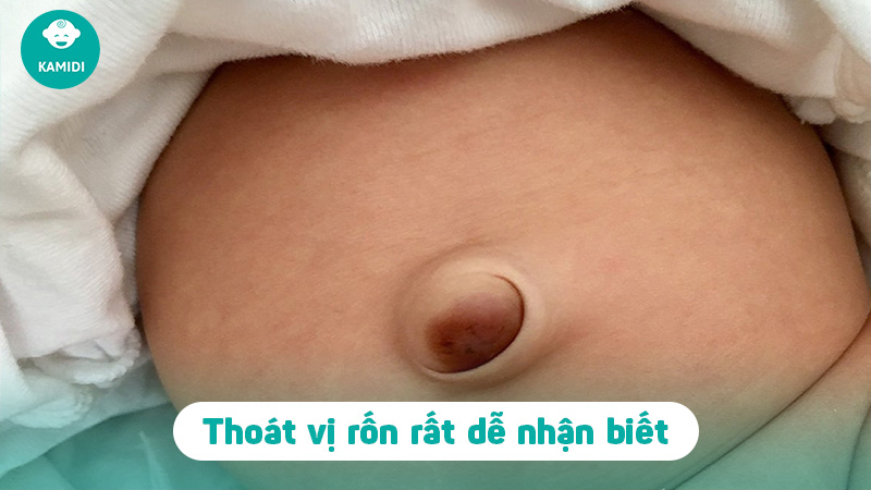 Thoát vị rốn ở trẻ sơ sinh: Nguyên nhân và cách điều trị 3 thoat-vi-ron-o-tre-so-sinh-2