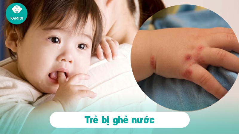 Trẻ bị ghẻ nước tắm lá gì mau hết? Mẹo dân gian trị ghẻ nước cho bé 2 tre-bi-ghe-nuoc-1