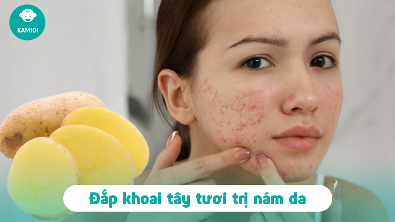 Mách mẹ cách trị nám da sau sinh đơn giản tại nhà 3 cach-tri-nam-da-sau-sinh-2