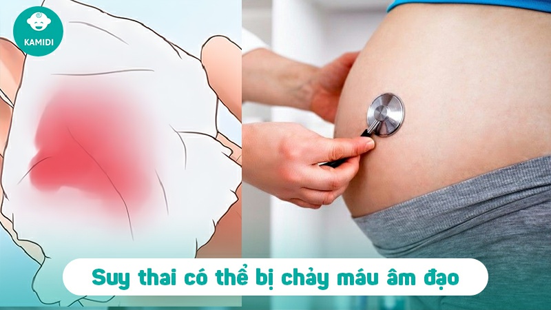 Dấu hiệu suy thai tháng cuối, nguyên nhân và cách điều trị 4 dau-hieu-suy-thai-thang-cuoi-3