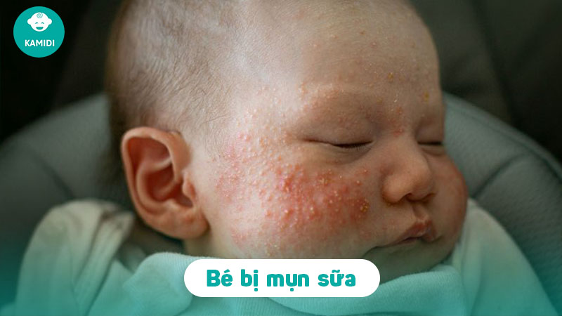 mun-sua-o-tre-so-sinh-1