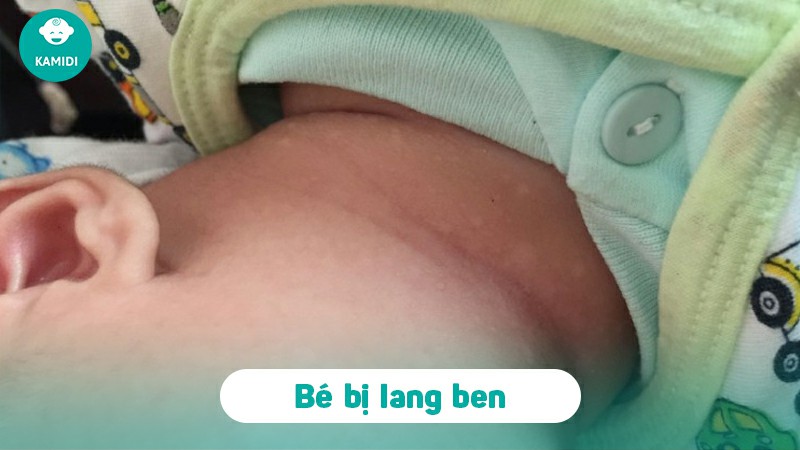 Lang ben ở trẻ sơ sinh có nguy hiểm không: Nguyên nhân và cách điều trị 2 lang-ben-o-tre-so-sinh-co-nguy-hiem-khong-1