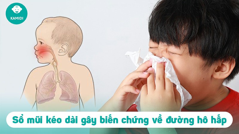 Trẻ bị sổ mũi kéo dài có nguy hiểm không? Nguyên nhân và cách xử lý 4 tre-bi-so-mui-keo-dai-3