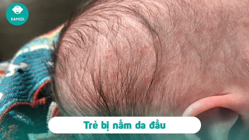 benh-nam-da-dau-o-tre-em-1