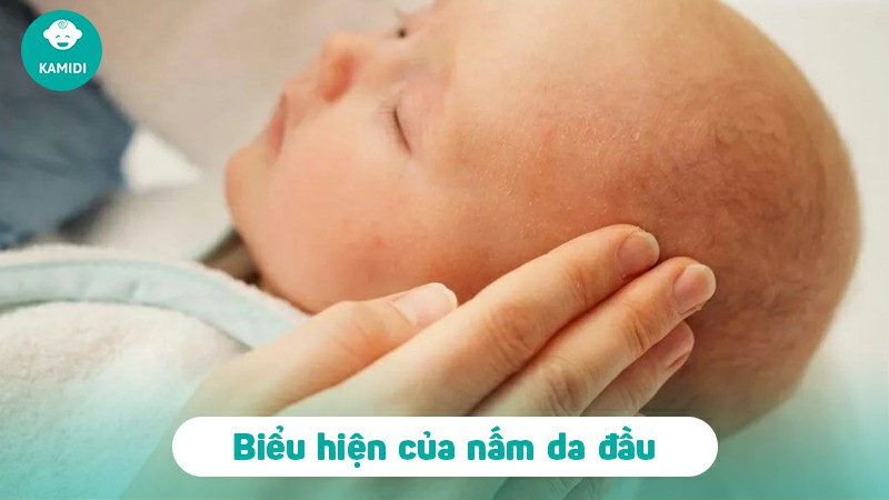 Những điều cần biết về bệnh nấm da đầu ở trẻ em 3 benh-nam-da-dau-o-tre-em-2