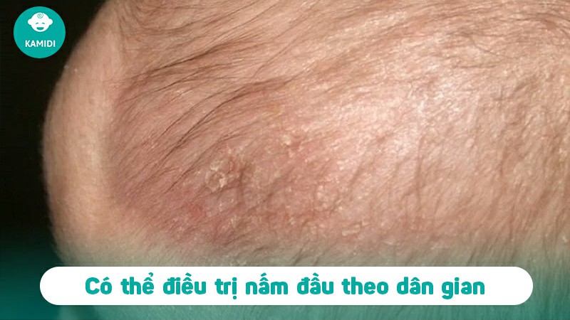 Những điều cần biết về bệnh nấm da đầu ở trẻ em 4 benh-nam-da-dau-o-tre-em-3