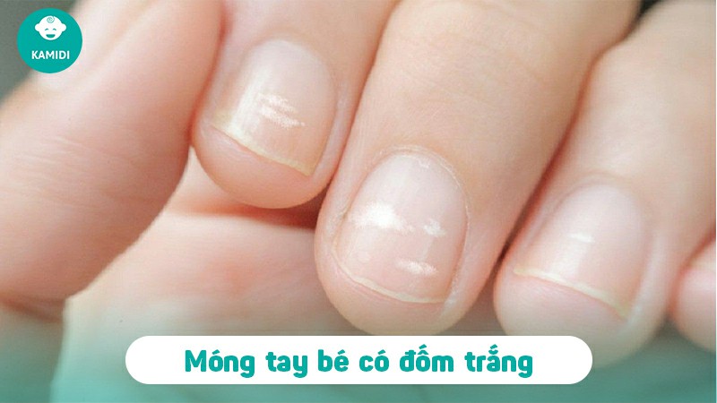 Móng tay có đốm trắng ở trẻ em: Nguyên nhân và cách điều trị 2 mong-tay-co-dom-trang-o-tre-em-1