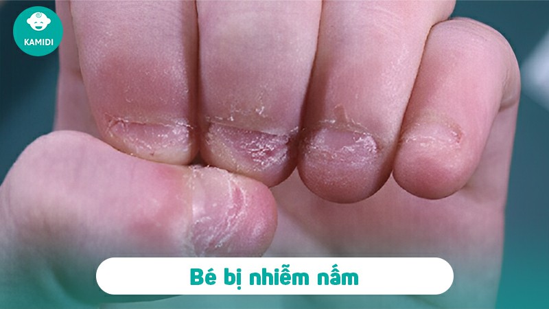 Móng tay có đốm trắng ở trẻ em: Nguyên nhân và cách điều trị 3 mong-tay-co-dom-trang-o-tre-em-2