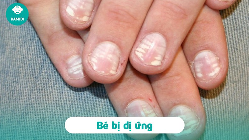 Móng tay có đốm trắng ở trẻ em: Nguyên nhân và cách điều trị 4 mong-tay-co-dom-trang-o-tre-em-3