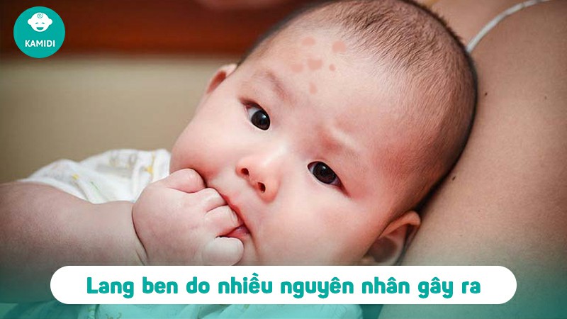 Lang ben ở trẻ sơ sinh có nguy hiểm không: Nguyên nhân và cách điều trị 3 lang-ben-o-tre-so-sinh-co-nguy-hiem-khong-2