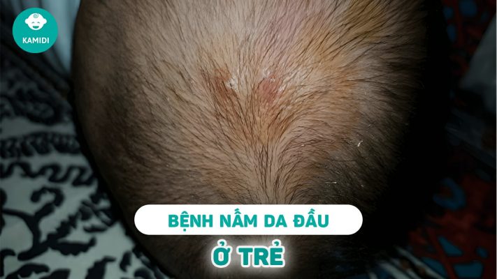 benh-nam-da-dau-o-tre-em