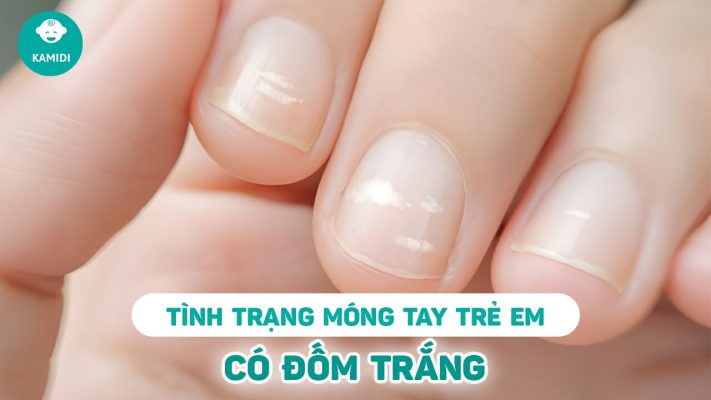 mong-tay-co-dom-trang-o-tre-em