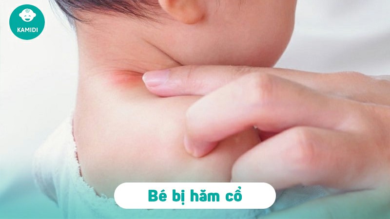 Bé bị hăm cổ: Nguyên nhân, dấu hiệu và cách điều trị 2 be-bi-ham-co-1