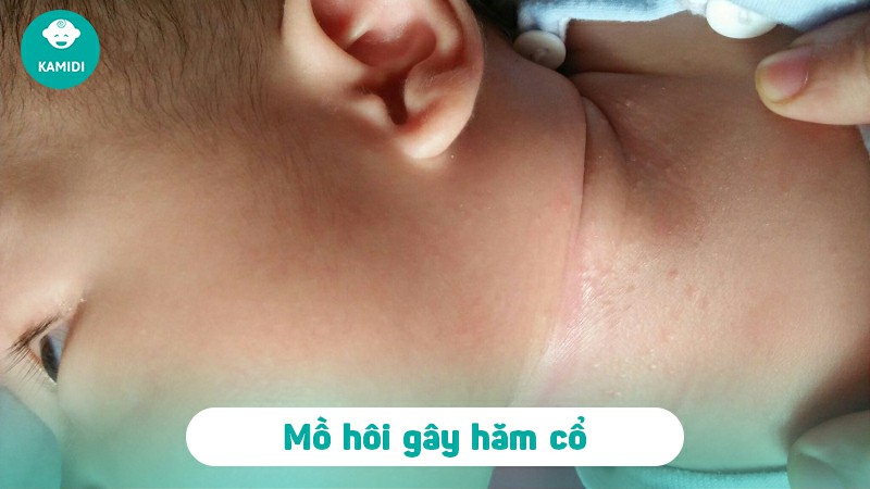 Bé bị hăm cổ: Nguyên nhân, dấu hiệu và cách điều trị 3 be-ham-co-2