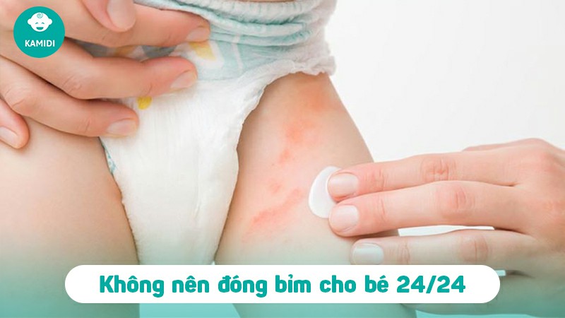 Có nên đóng bỉm 24/24 cho trẻ sơ sinh? Những lưu ý khi đóng bỉm cho trẻ sơ sinh 2 dong-bim-cho-tre-so-sinh-1